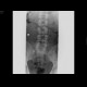 Spondylolisthesis, spondylolysis, spina bifida: X-ray - Plain radiograph